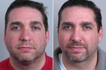 Male Rhinoplasty Patient 2