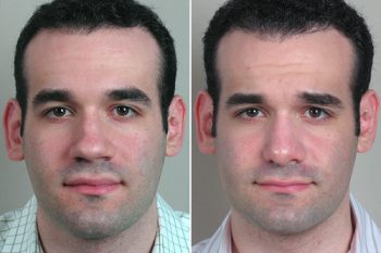 Male Rhinoplasty Patient 3
