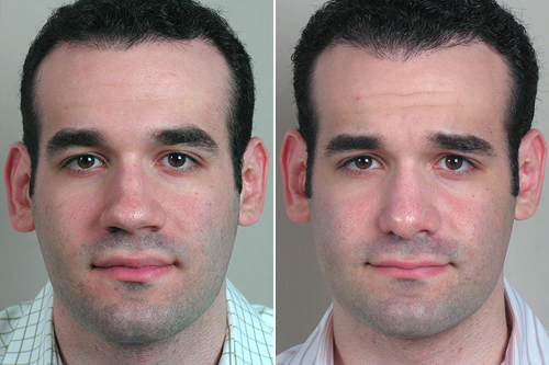 Male Rhinoplasty Patient 3