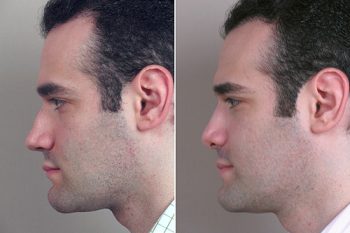 Male Rhinoplasty Patient 3