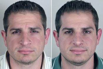 Male Rhinoplasty Patient 5