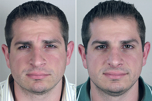 Male Rhinoplasty Patient 5