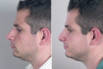 Male Rhinoplasty Patient 5