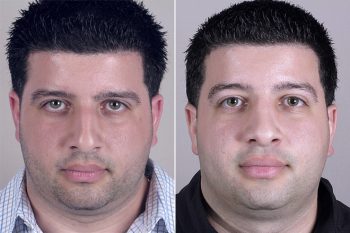Male Rhinoplasty Patient 6