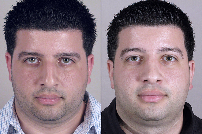 Male Rhinoplasty Patient 6