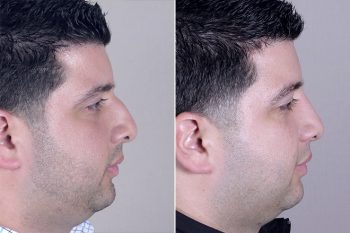 Male Rhinoplasty Patient 6