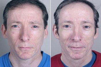 Male Rhinoplasty Patient 7