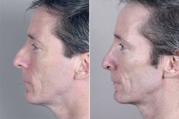 Male Rhinoplasty Patient 7