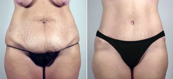 Breast Lift (Vertical Mastopexy Only) Patient 12