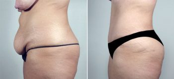 Breast Lift (Vertical Mastopexy Only) Patient 12