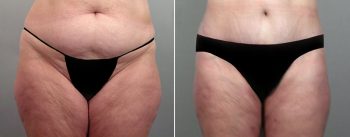 Mommy Makeover Patient 4