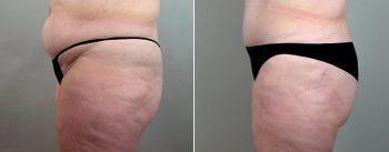 Mommy Makeover Patient 4