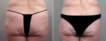 Mommy Makeover Patient 4