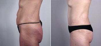 Mommy Makeover Patient 10