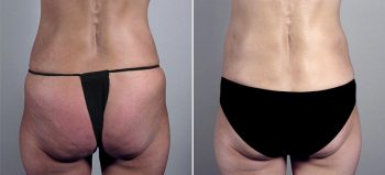 Mommy Makeover Patient 10