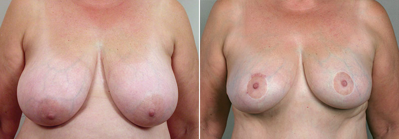 Mommy Makeover Patient 4