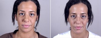 Neck Liposuction Patient 4