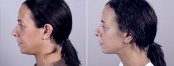 Neck Liposuction Patient 4