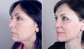 Neck Lift Patient 4
