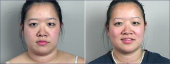 Neck Liposuction Patient 2