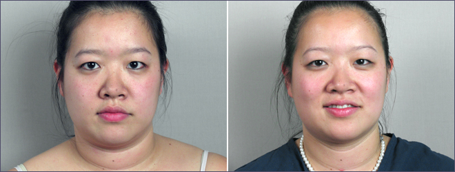Neck Liposuction Patient 2