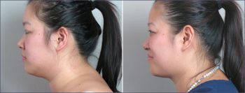 Neck Liposuction Patient 2