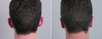 Otoplasty Patient 22