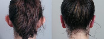 Otoplasty Patient 2