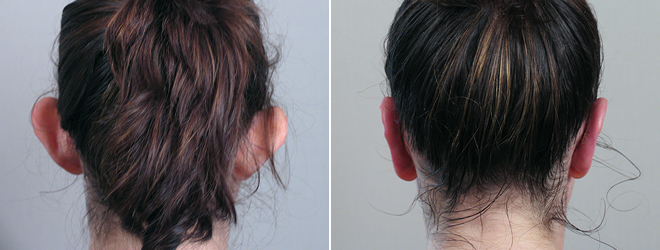 Otoplasty Patient 2