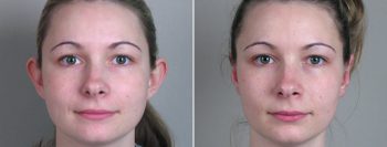 Otoplasty Patient 1
