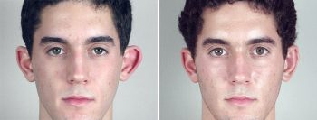 Otoplasty Patient 1-2