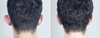 Otoplasty Patient 1-2