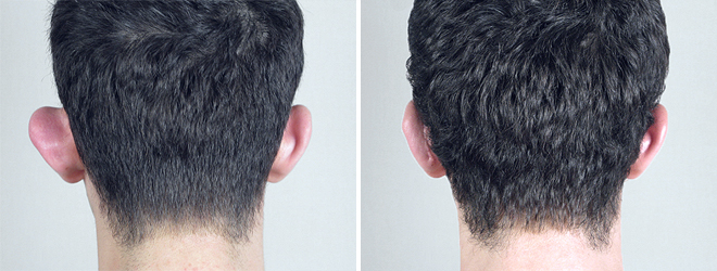 Otoplasty Patient 1-2