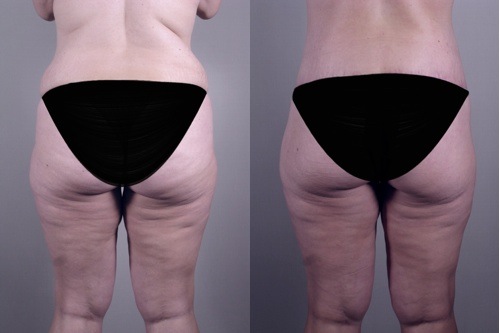 pc_lipoabdominoplasty_beforeafter_back.jpg