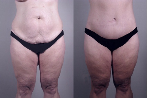 pc_lipoabdominoplasty_beforeafter_front.jpg