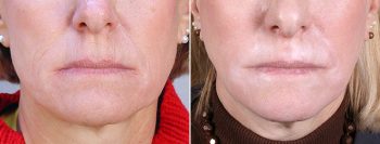 Wrinkle Reduction Patient 4 – Dermabrasion