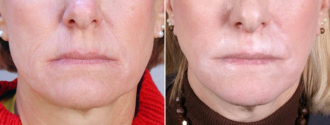 Wrinkle Reduction Patient 4 – Dermabrasion