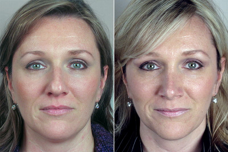 Rhinoplasty Patient 1