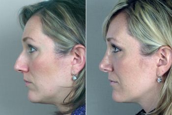 Rhinoplasty Patient 1