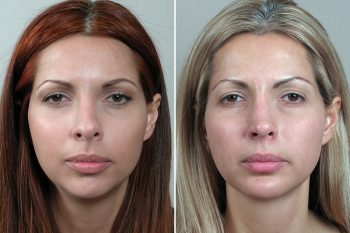 Rhinoplasty Patient 9