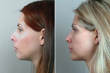 Rhinoplasty Patient 9