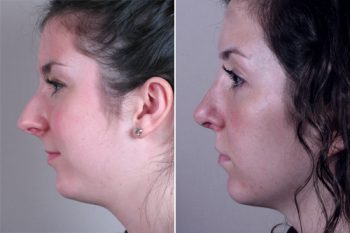 Rhinoplasty Patient 12