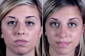 Rhinoplasty Patient 13