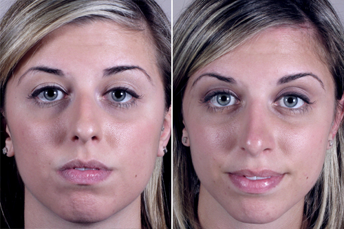 Rhinoplasty Patient 13