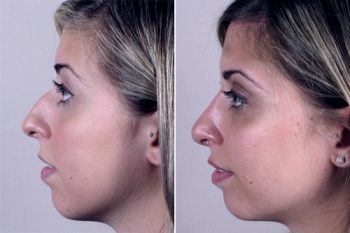 Rhinoplasty Patient 13