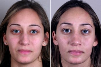 Rhinoplasty Patient 14