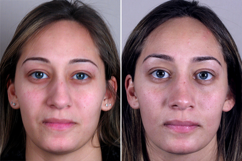 Rhinoplasty Patient 14