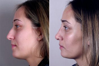 Rhinoplasty Patient 14