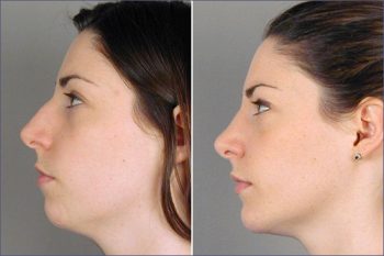Rhinoplasty & Chin Implant Patient 8