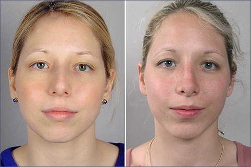 Rhinoplasty & Chin Implant Patient 2